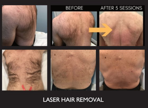 Before and After IPL Hair Removal, The Results