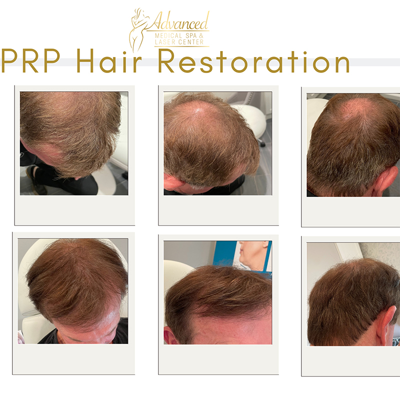 Hair Restoration